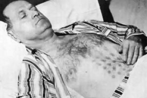 UFO Left Man With Severe Burns And Melted Fingertips