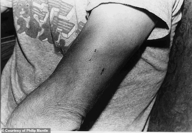 The two Pascagoula witnesses had physical injuries from the encounter