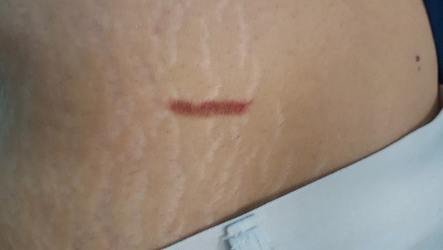 The Iranian woman woke up with scars on her abdomen (MUFON)